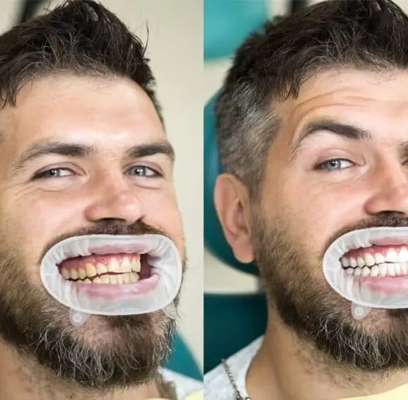 Teeth Whitening Options in Marmaris: Brighten Your Smile Safely