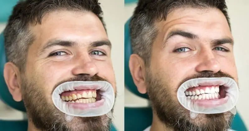 Teeth Whitening Options in Marmaris: Brighten Your Smile Safely