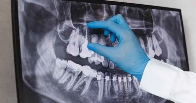 Root canal vs Extraction Root canal vs Extraction