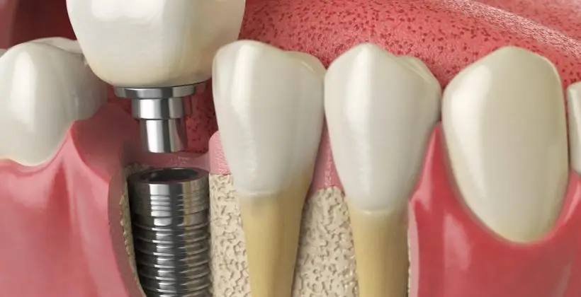 How much does a full set of teeth implants cost in Turkey? How much does a full set of teeth implants cost in Turkey?