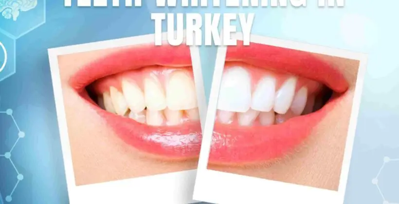 Teeth Whitening in Turkey