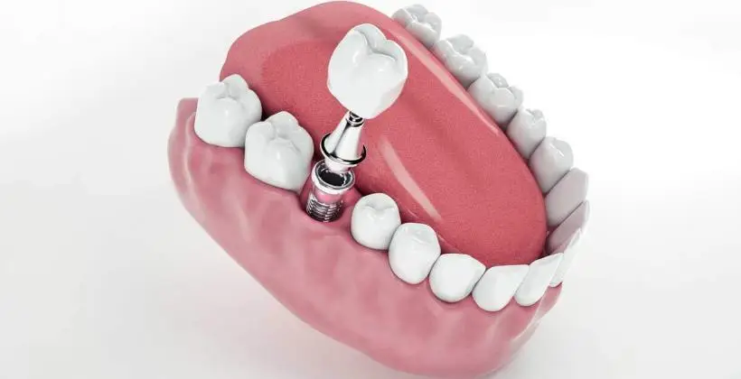 How to Get a Dental Implant and What to Expect