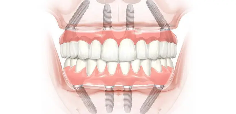 All-on-4 Dental Implants and The Cost in The UK.